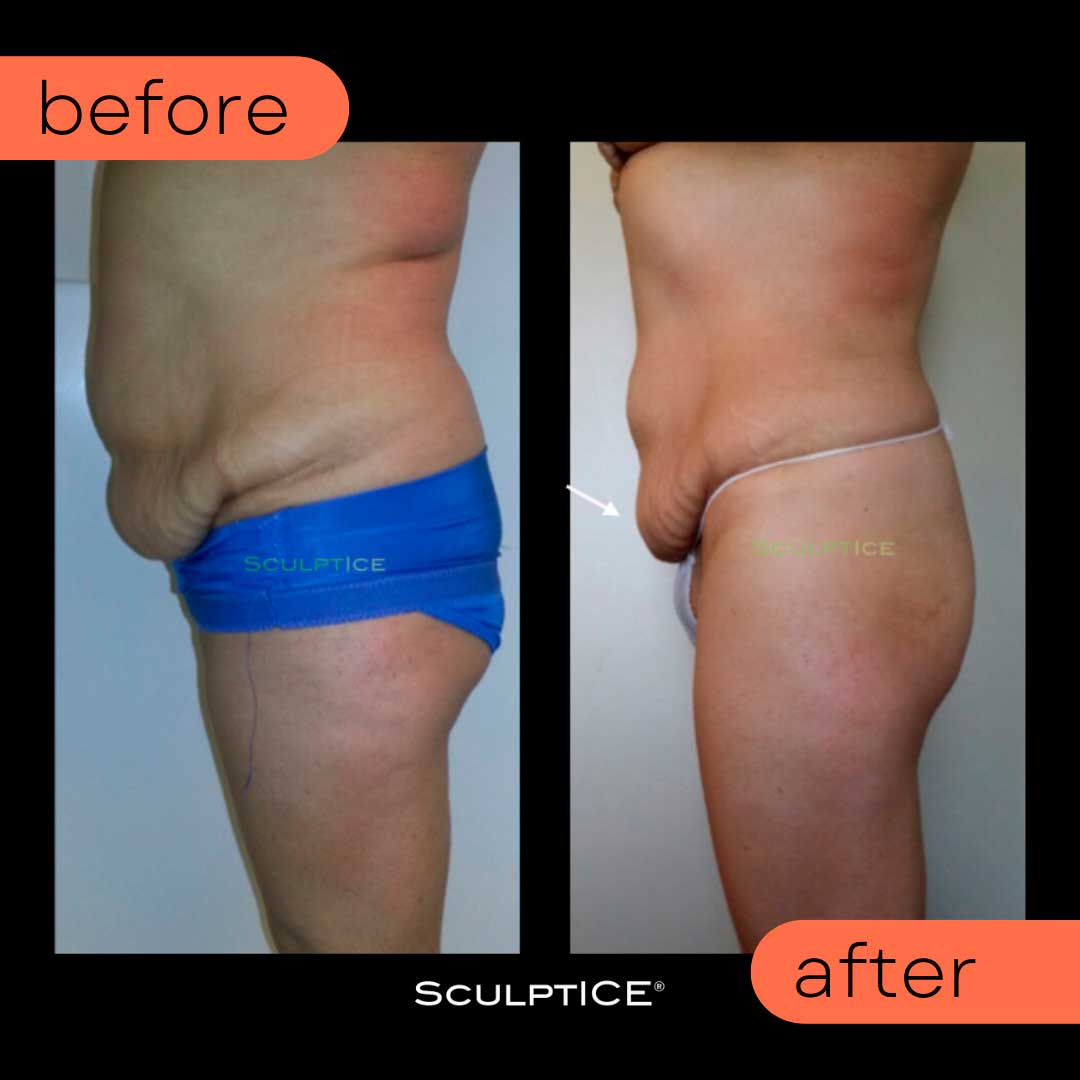 Before and After - SculptICE Services