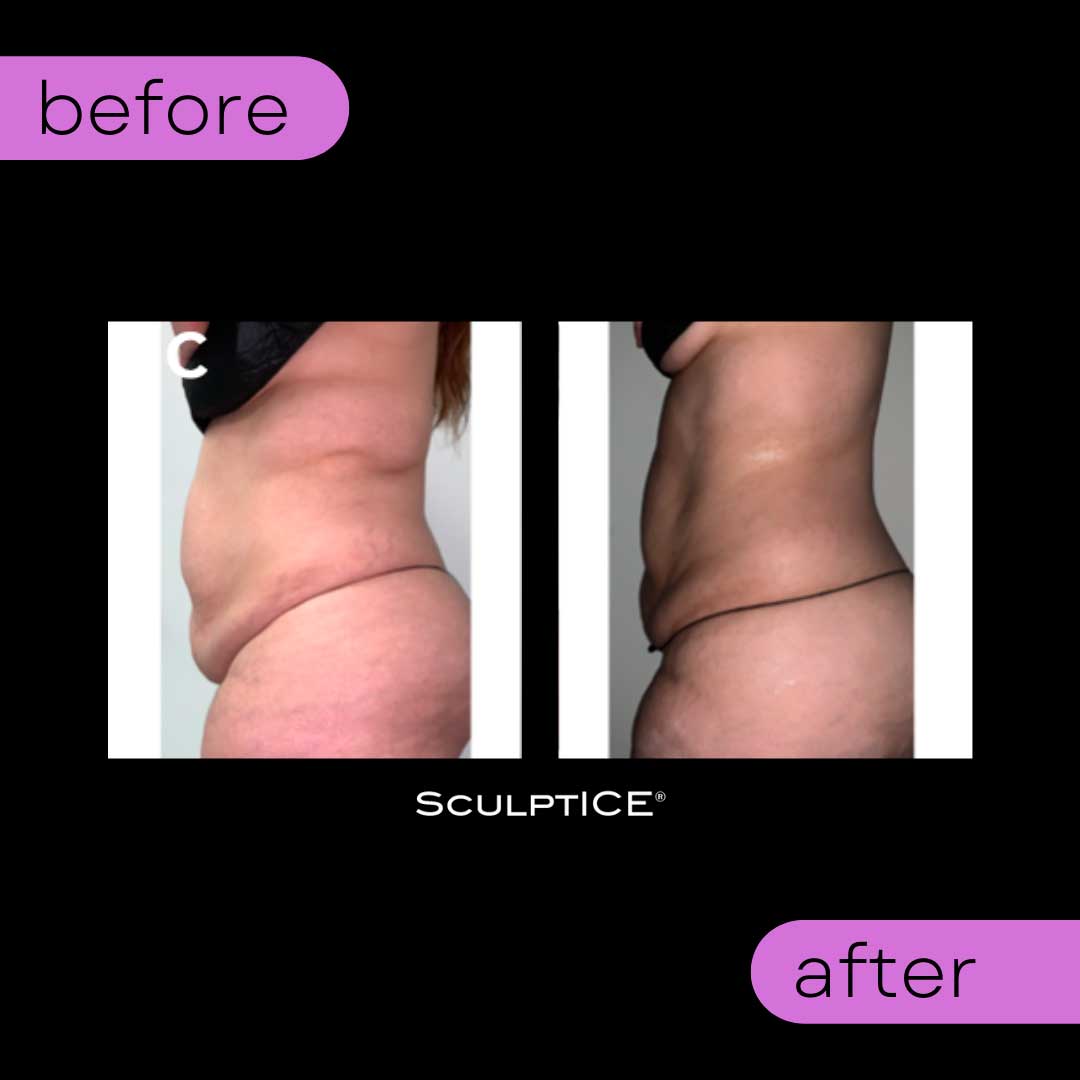Before and After - SculptICE Services