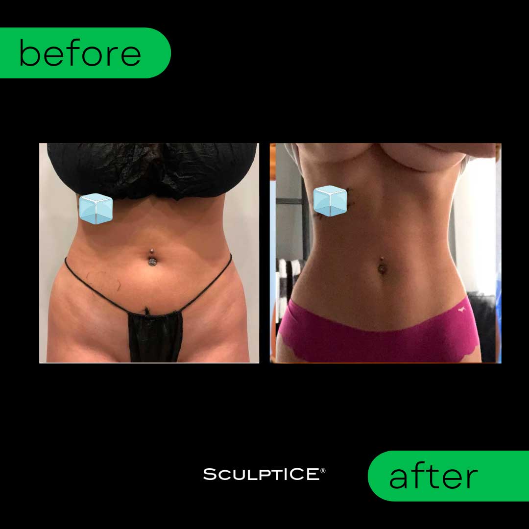 Before and After - Snatched Waist by SculptICE