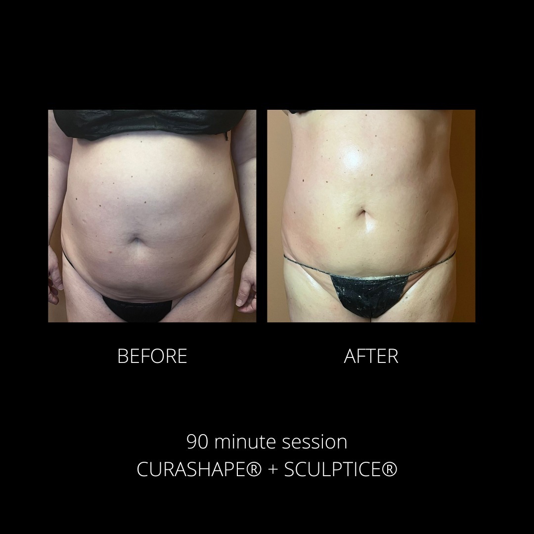 CuraShape and SculptICE - 90 minute session